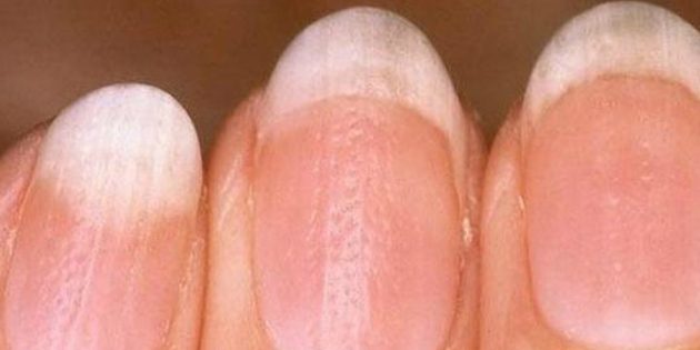 точечные лунки на ногтях